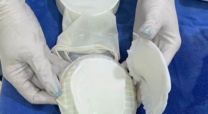 Tecnologia: HUOP realiza primeira cirurgia craniana com molde criado em impressora 3D